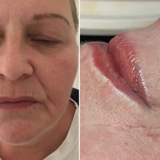 Joanne Walton Before and After Lip Treatment