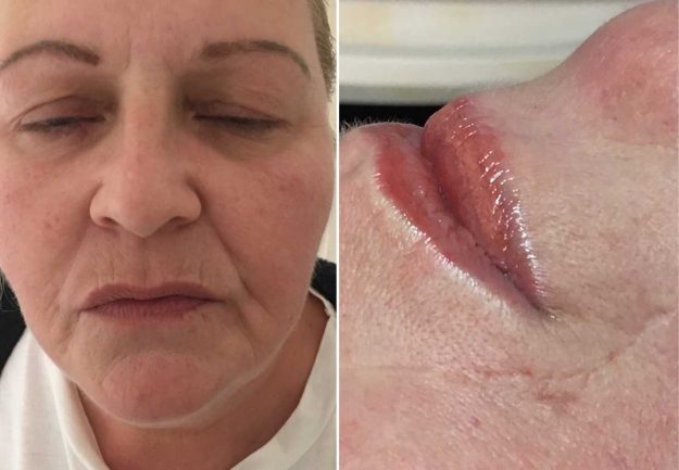 Joanne Walton Before and After Lip Treatment